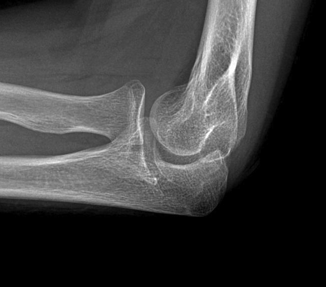 Elbow Malunion Lateral